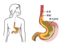 呼和浩特东大肛肠医院提醒 经常反酸烧心不可放任不管